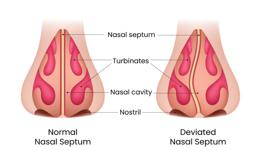 Deviated Nasal Septum: When Blocked Breathing Needs Surgery (Septoplasty)